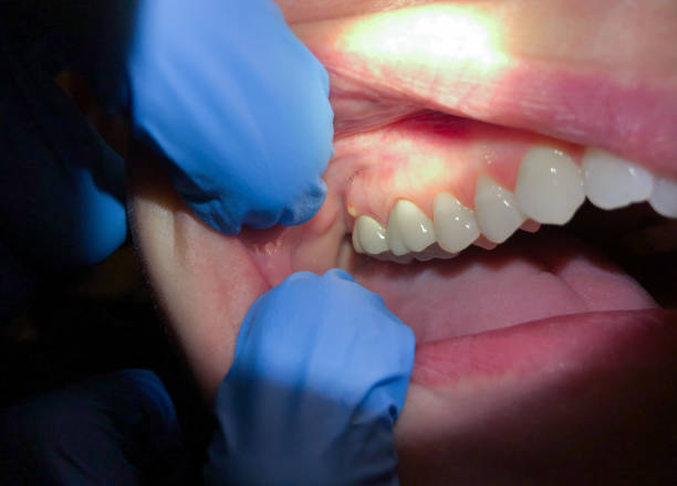 Best Urgent Dental Care for Toothache in St Clairsville, OH