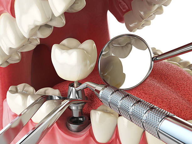 Best Broken or Cracked Tooth Emergency Dentist in St Clairsville, OH